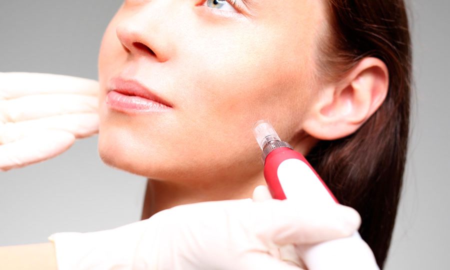 terapia-del-microneedle-aqua-clinica-blog-min