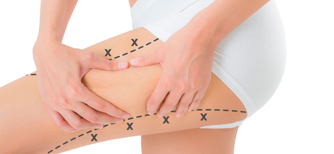 carboxiterapia flacidez