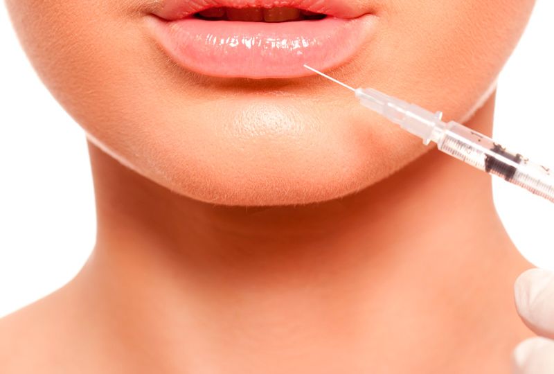 Relleno de labios con ácido hialurónico