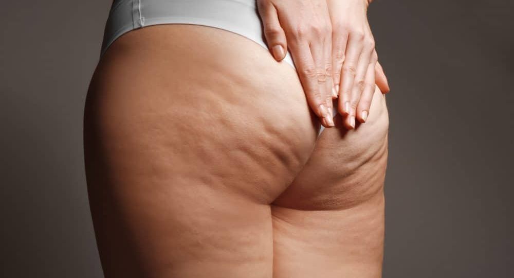 Celulitis mitos realidades y soluciones