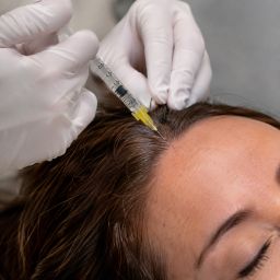 Cómo funciona el PRF para la caída del pelo: todo lo que debes saber