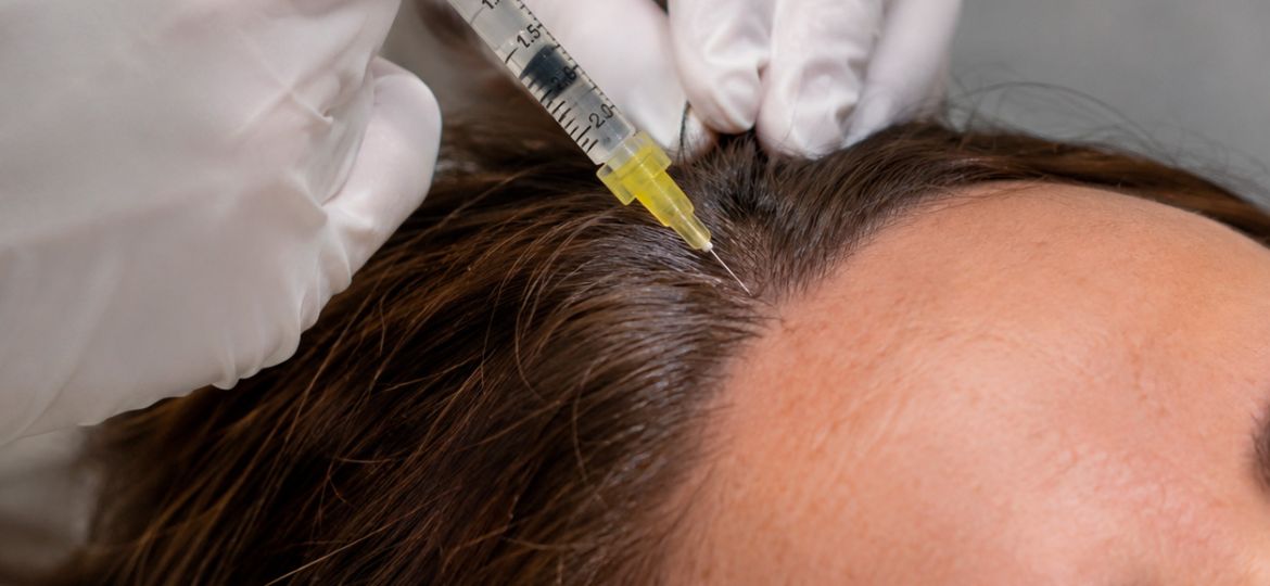 Cómo funciona el PRF para la caída del pelo: todo lo que debes saber