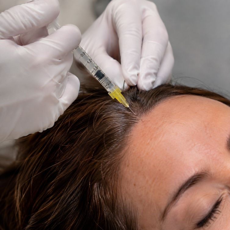 Cómo funciona el PRF para la caída del pelo: todo lo que debes saber